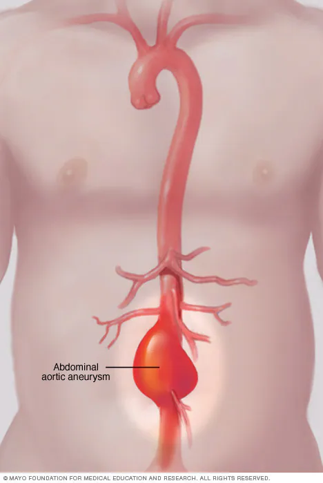 Aortic Disease Treatment in Mohali & Chandigarh