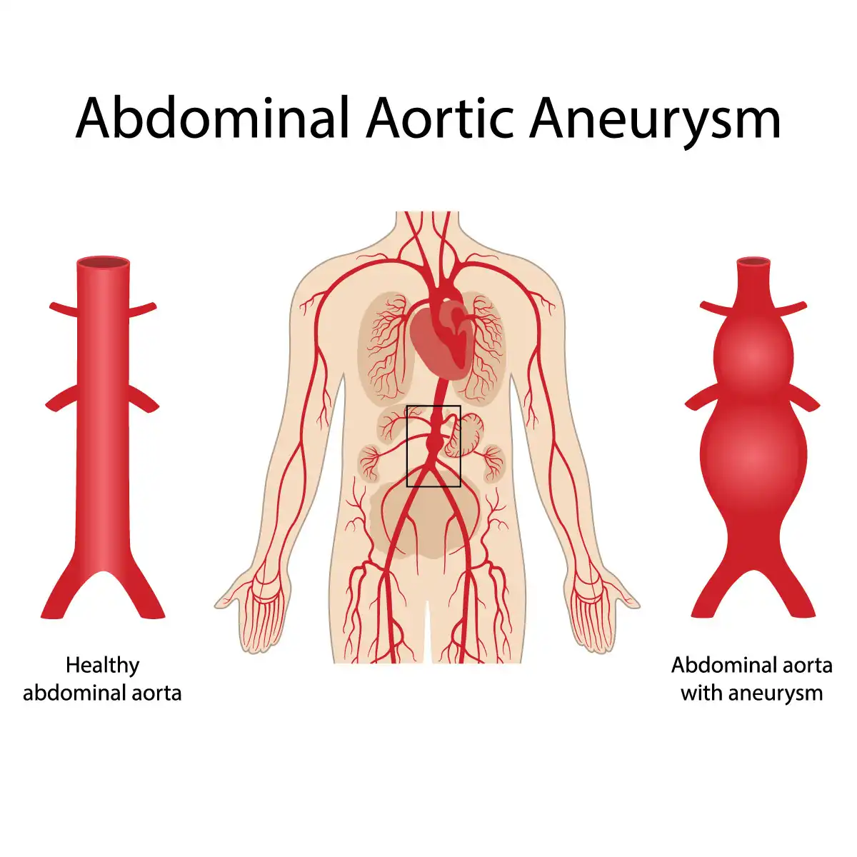 Aortic Disease Treatment in Mohali & Chandigarh