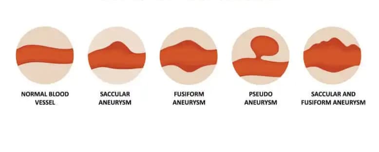 Aortic Disease Treatment in Mohali & Chandigarh