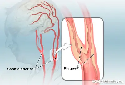 Carotid Artery Disease Treatment in Mohali