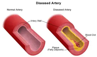 Carotid Artery Disease Treatment in Mohali