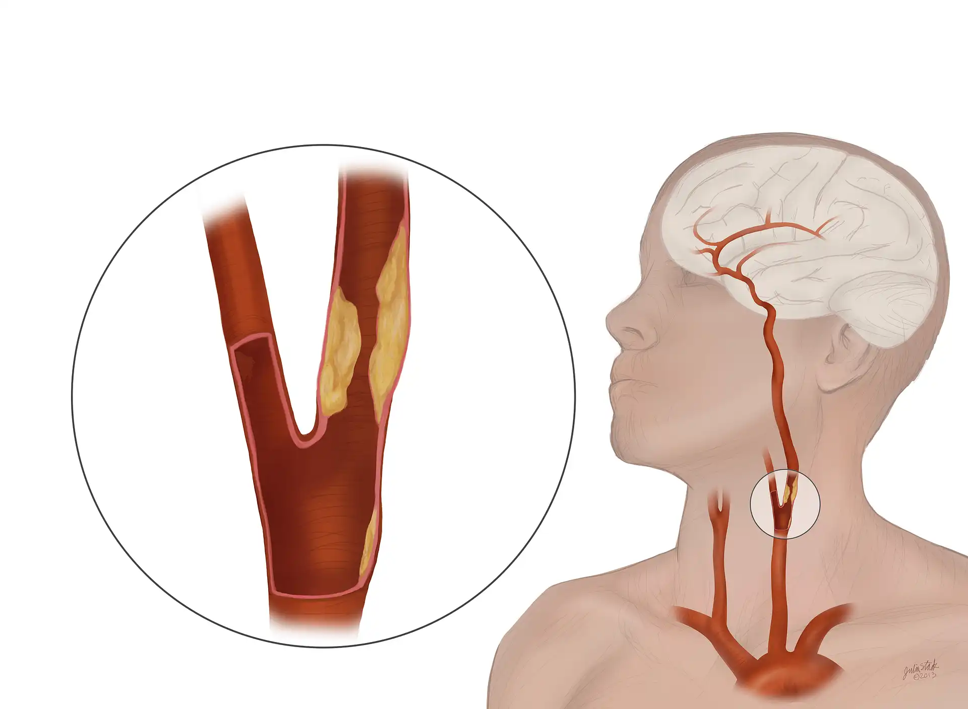Carotid Artery Disease Treatment in Mohali