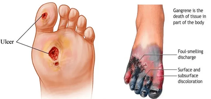 Critical Limb Ischemia Treatment in Mohali