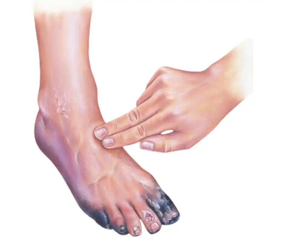 Critical Limb Ischemia Treatment in Mohali