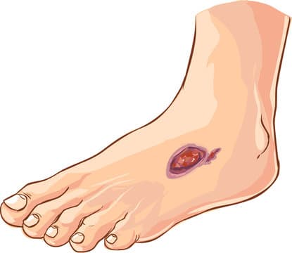Diabetic Foot Ulcer Care and Treatment in Mohali by Dr. Ravul Jindal