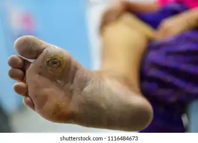 Diabetic Foot Ulcer Care and Treatment in Mohali by Dr. Ravul Jindal