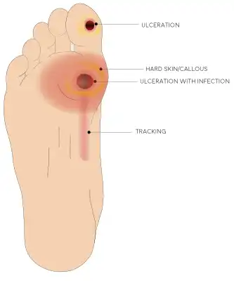 What is Diabetic Foot Ulcer ?