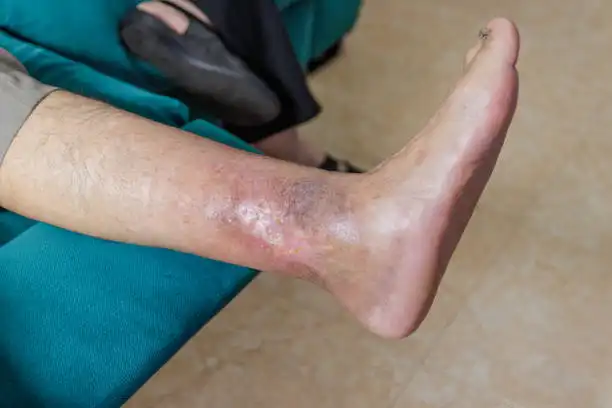 Diabetic Foot Ulcer Care and Treatment in Mohali by Dr. Ravul Jindal