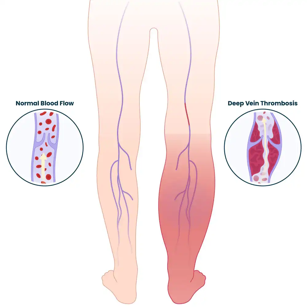Deep Vein Thrombosis Treatment in Mohali by Dr. Ravul Jindal