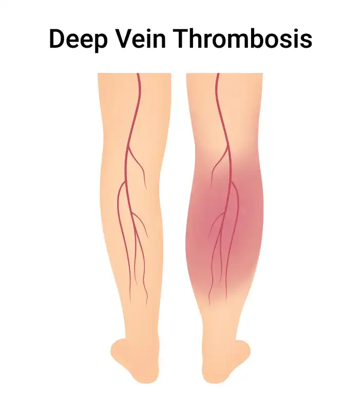 What is Deep Vein Thrombosis ?