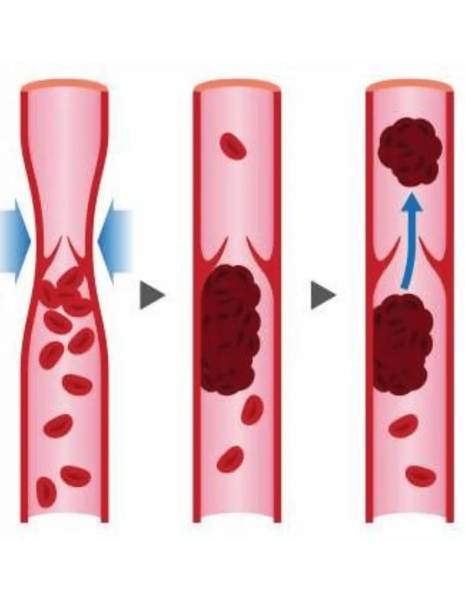 Deep Vein Thrombosis Treatment in Mohali by Dr. Ravul Jindal