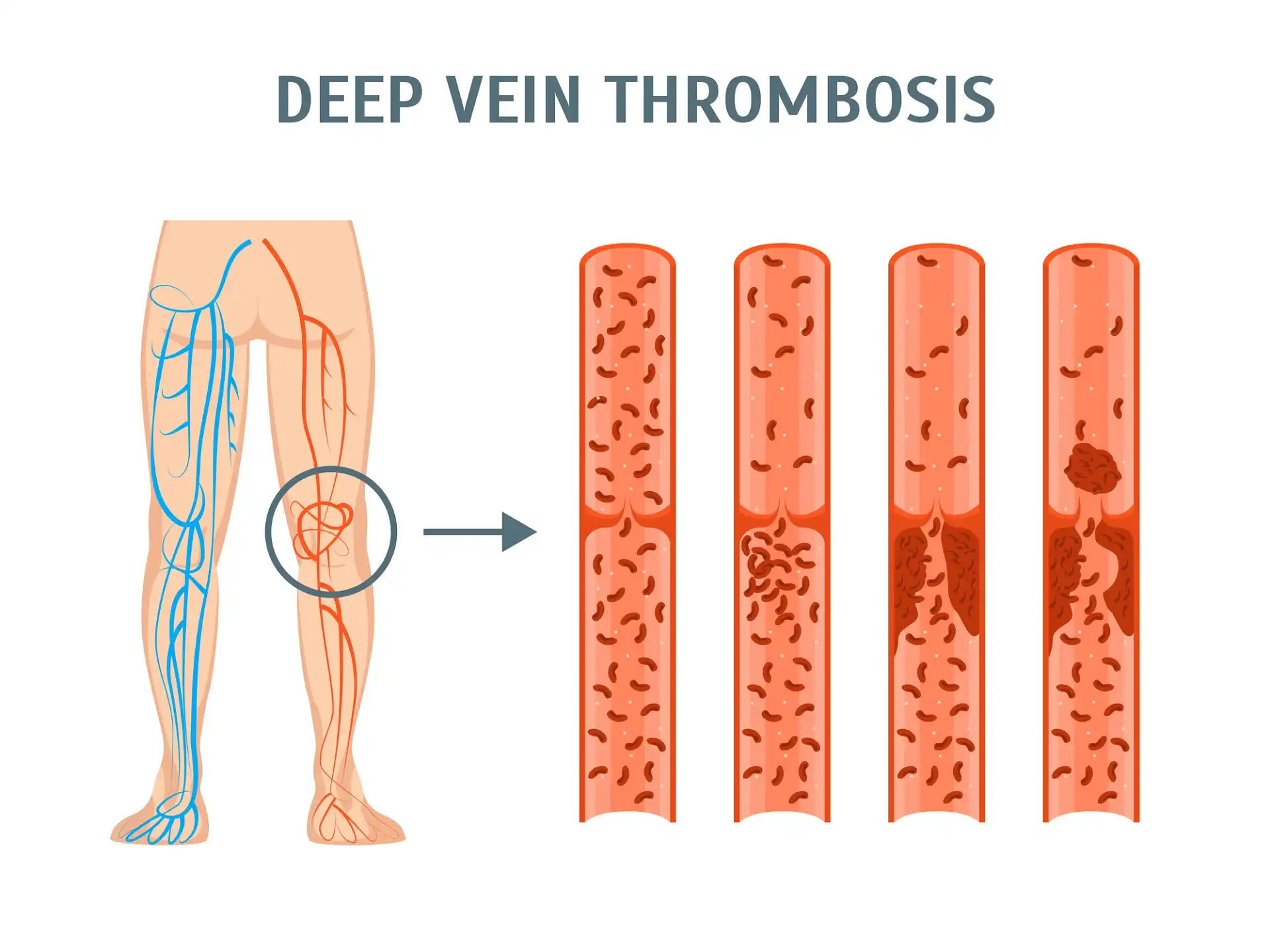 Deep Vein Thrombosis Treatment in Mohali by Dr. Ravul Jindal
