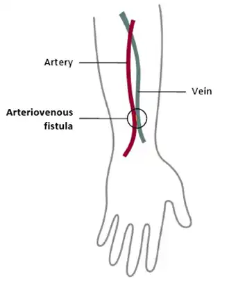 AV Fistula Surgery in Mohali | Expert Dialysis Vascular Access by Dr. Ravul Jindal