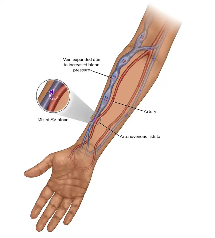 What is an AV Fistula?