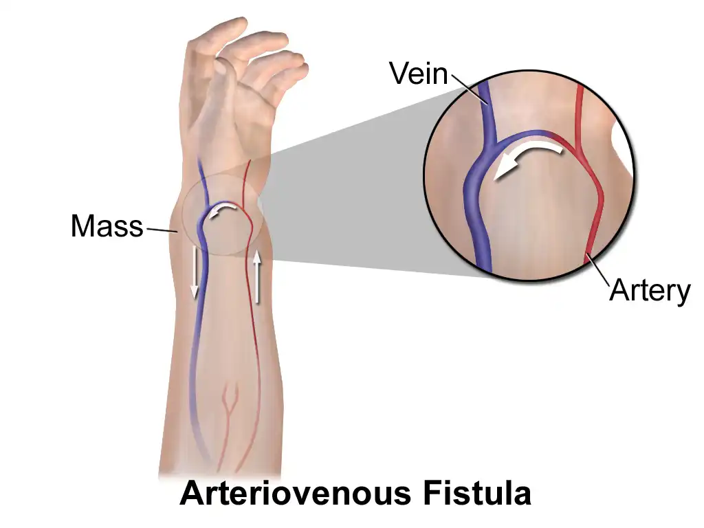 AV Fistula Surgery in Mohali | Expert Dialysis Vascular Access by Dr. Ravul Jindal