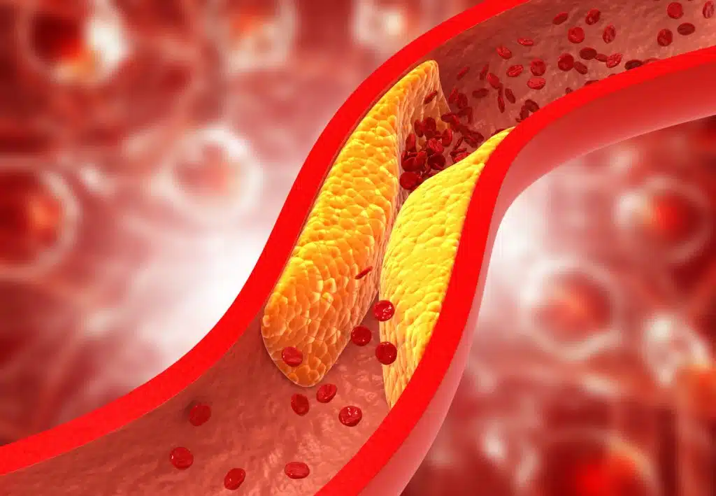 What is Peripheral Artery Disease?