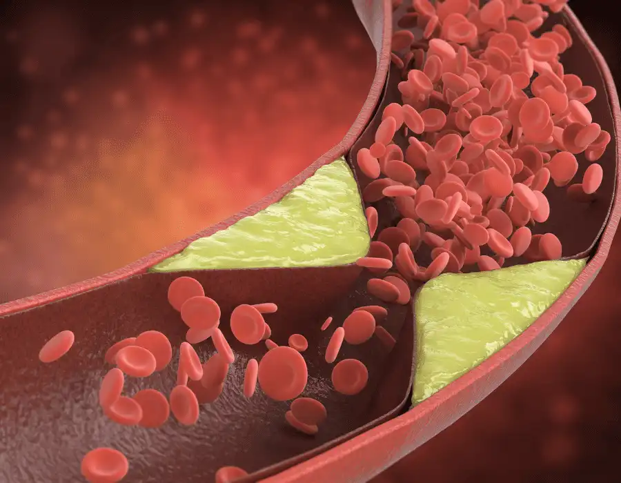 Peripheral Artery Disease Treatment in Mohali