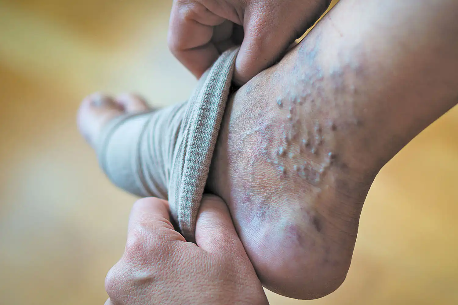 Best Varicose Veins Doctor Near Phase 8A, Mohali - Image 1