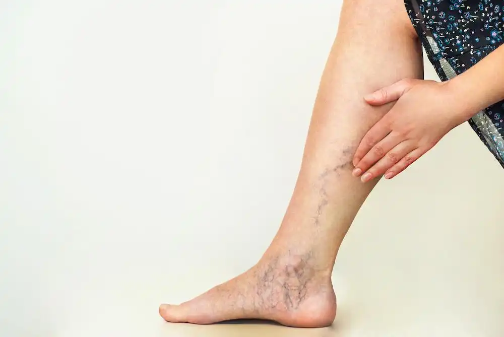 Best Varicose Veins Doctor Near Phase 8A, Mohali - Image 3