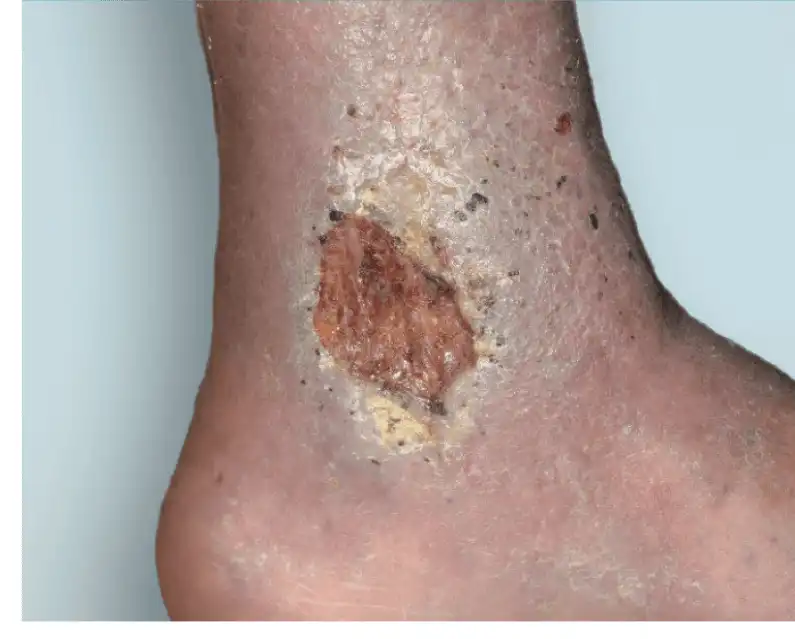 Venous Ulcer Treatment in Mohali - Expert Vascular Care