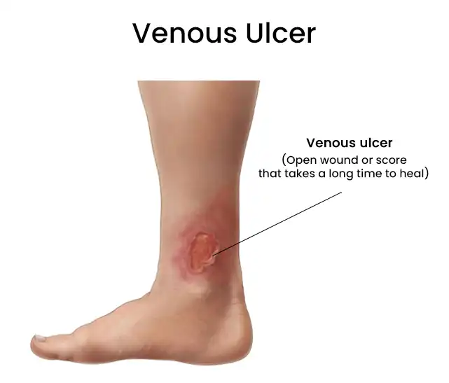 Venous Ulcer Treatment in Mohali - Expert Vascular Care