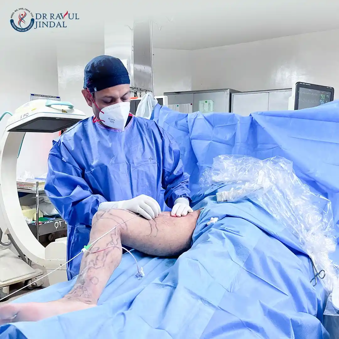 Varicose veins treatment procedure at Fortis Hospital Mohali