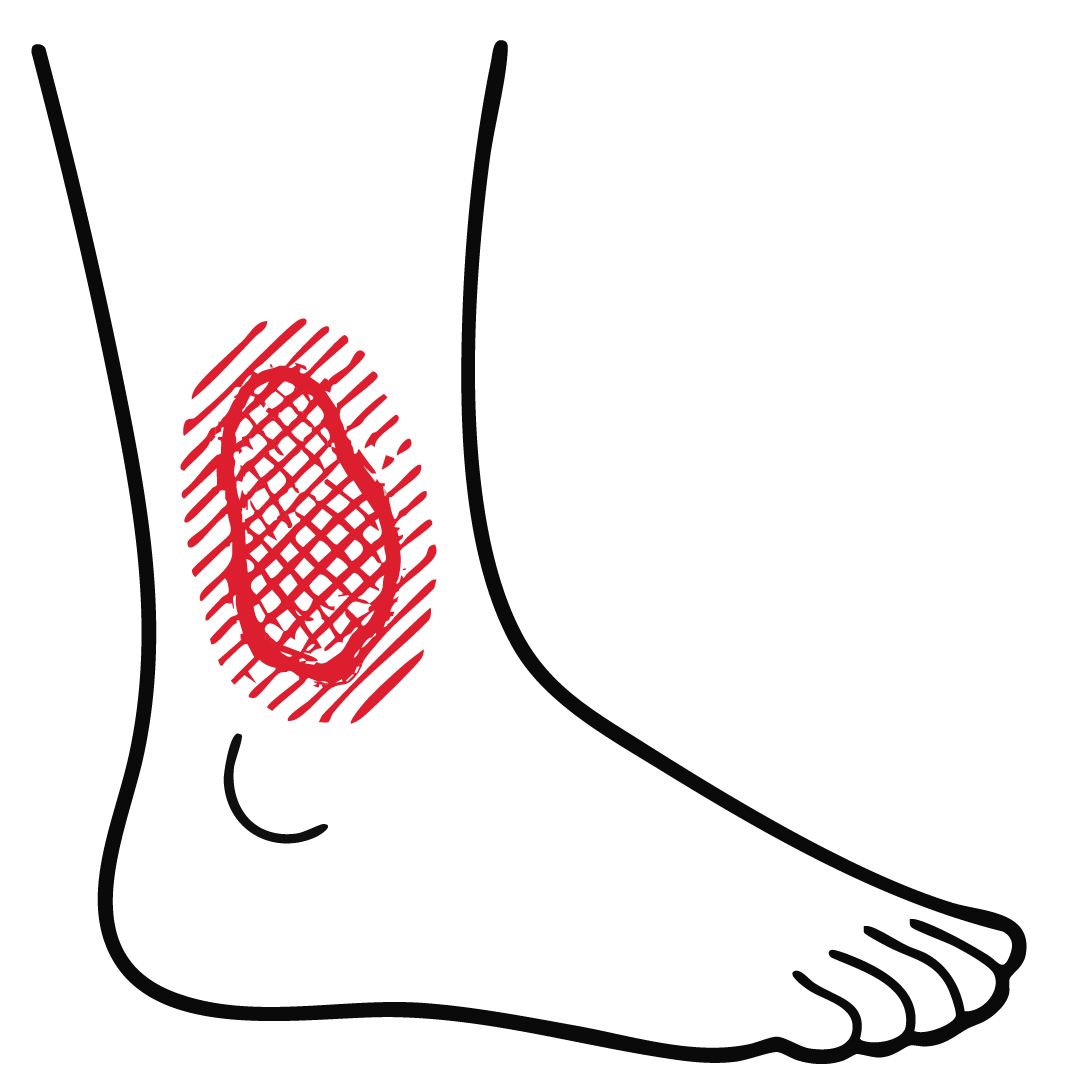 VENOUS ULCERS