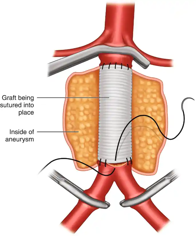 Best Aortic Aneurysm Repair in Mohali by Expert Vascular Surgeon