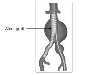 What Is an Aortic Aneurysm and Why Does It Need Treatment?