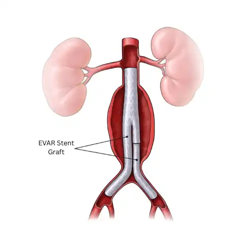 Endovascular Aneurysm Repair in Mohali - Minimally Invasive EVAR Surgery