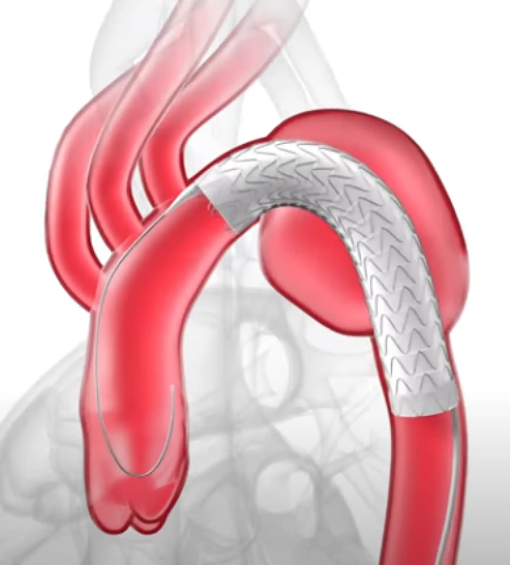 What is Thoracic Endovascular Aortic Repair (TEVAR)?