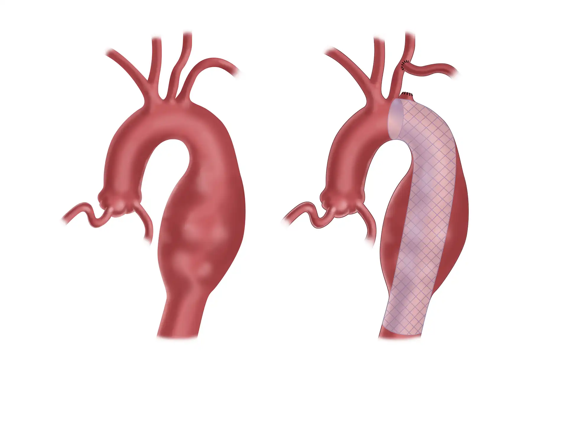 Thoracic Endovascular Aortic Repair in Mohali