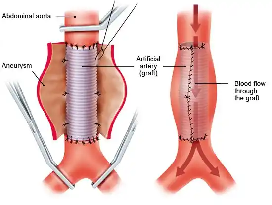 What is an Aortic Aneurysm?