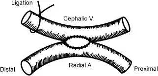 What Is Radiocephalic AV Fistula?