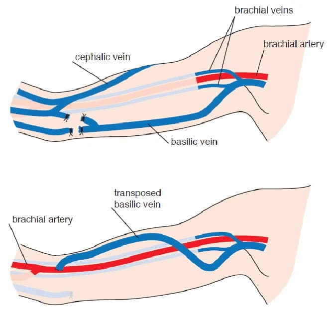 Basilic Vein Transposition Surgery in Mohali by Expert Dr. Ravul Jindal