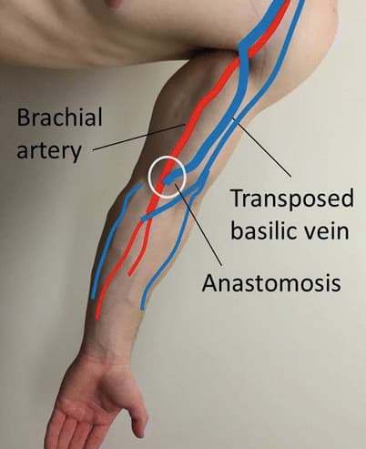 What is Basilic Vein Transposition (BVT)?