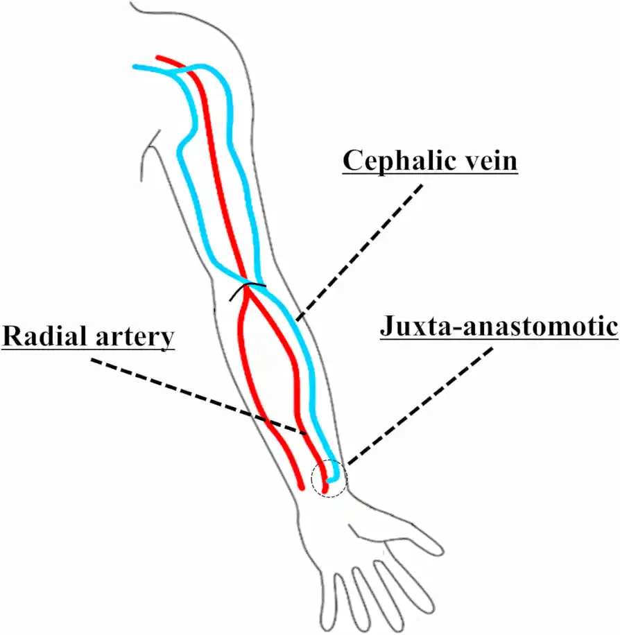 What is Basilic Vein Transposition (BVT)?