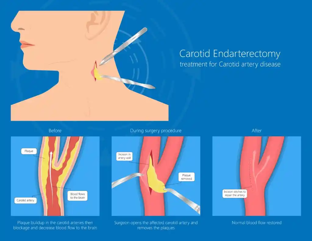 Venous Recanalization
