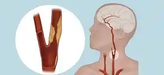 Carotid Endarterectomy (CEA)