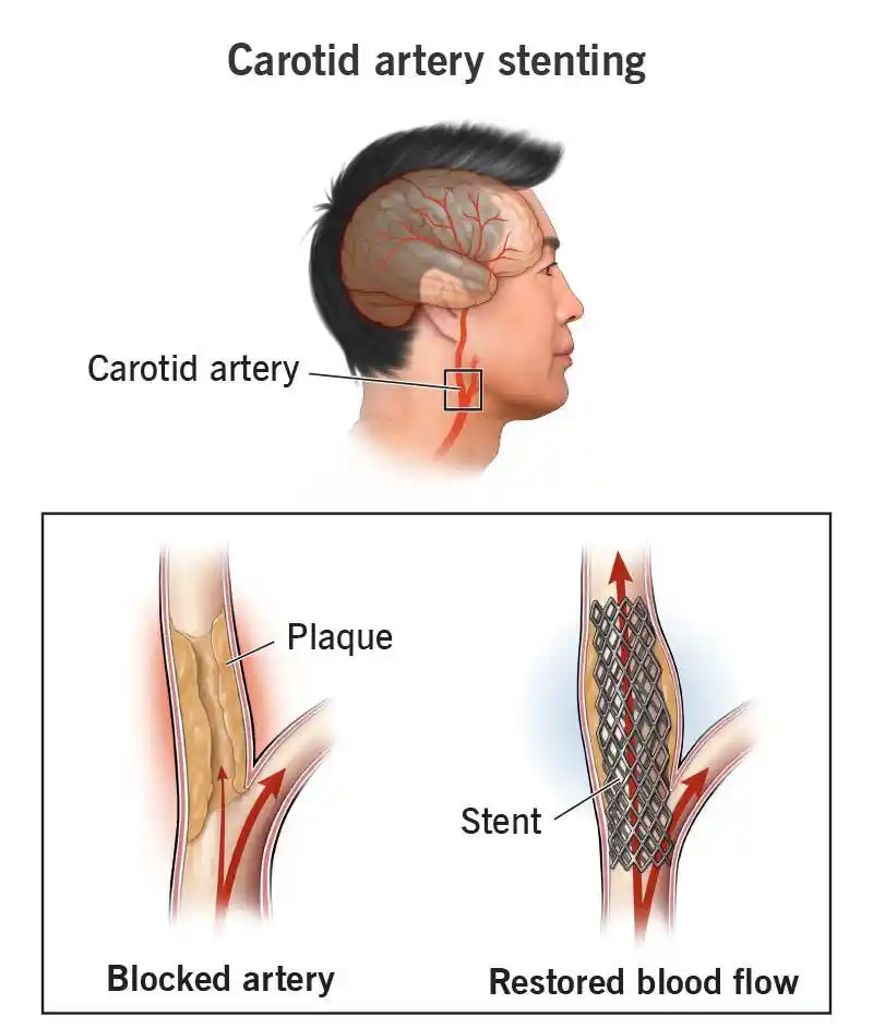 Expert Carotid Endarterectomy Care & Surgery in Mohali