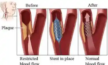 Carotid Angioplasty & Stenting
