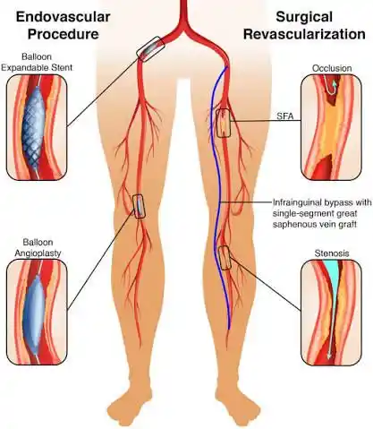 Hybrid Revascularization in Mohali | Dr. Ravul Jindal