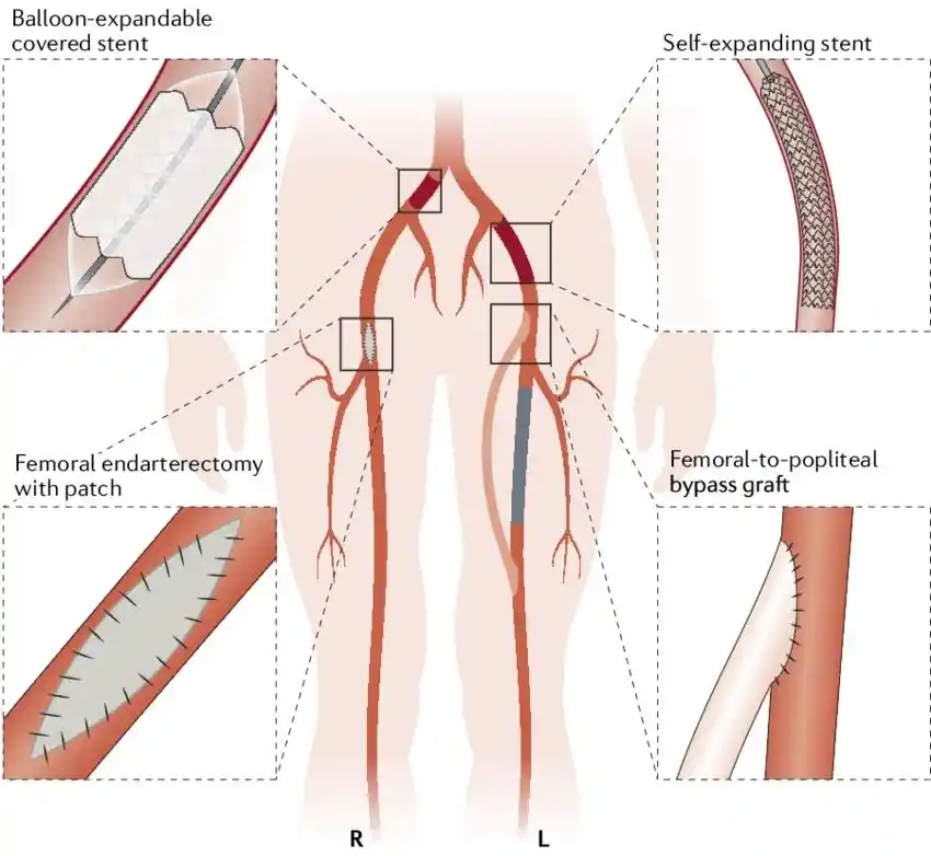 What Is Hybrid Revascularization Surgery?