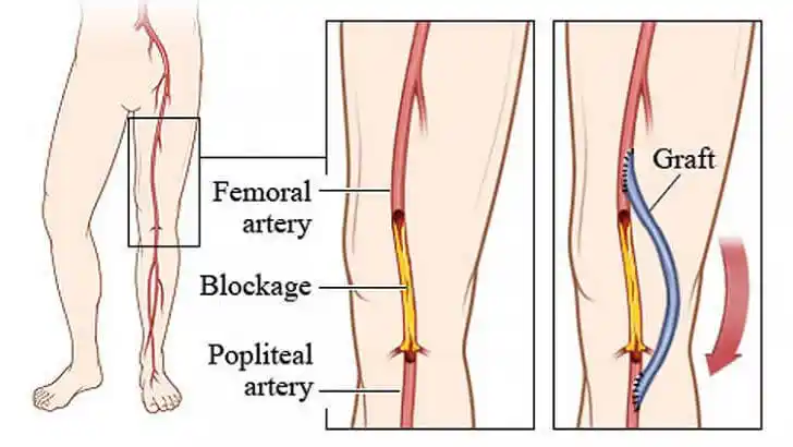 What is Distal Bypass Surgery?