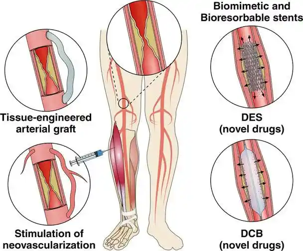 Foot Revascularization