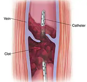 Catheter Directed Thrombolysis