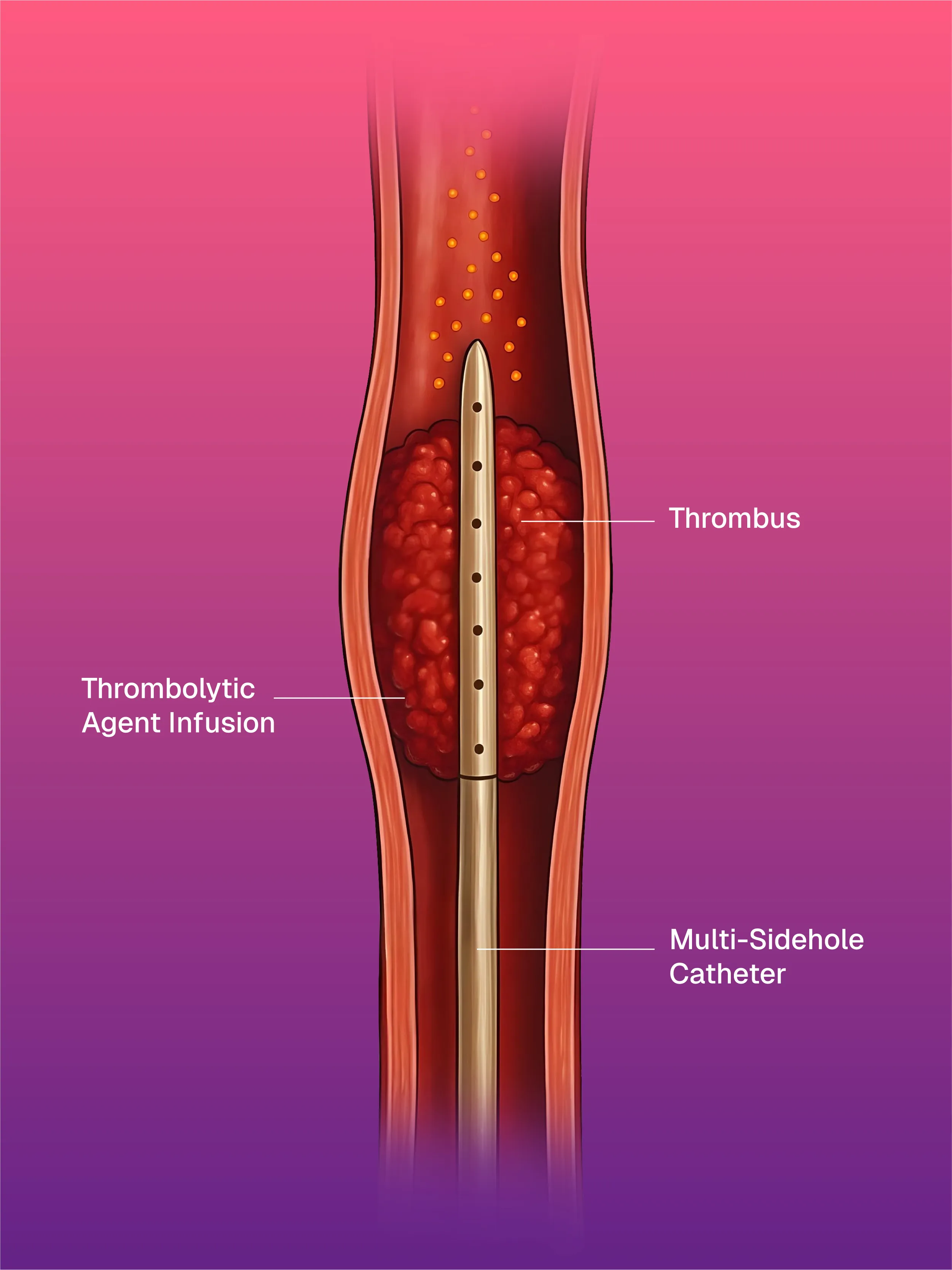 Catheter Directed Thrombolysis