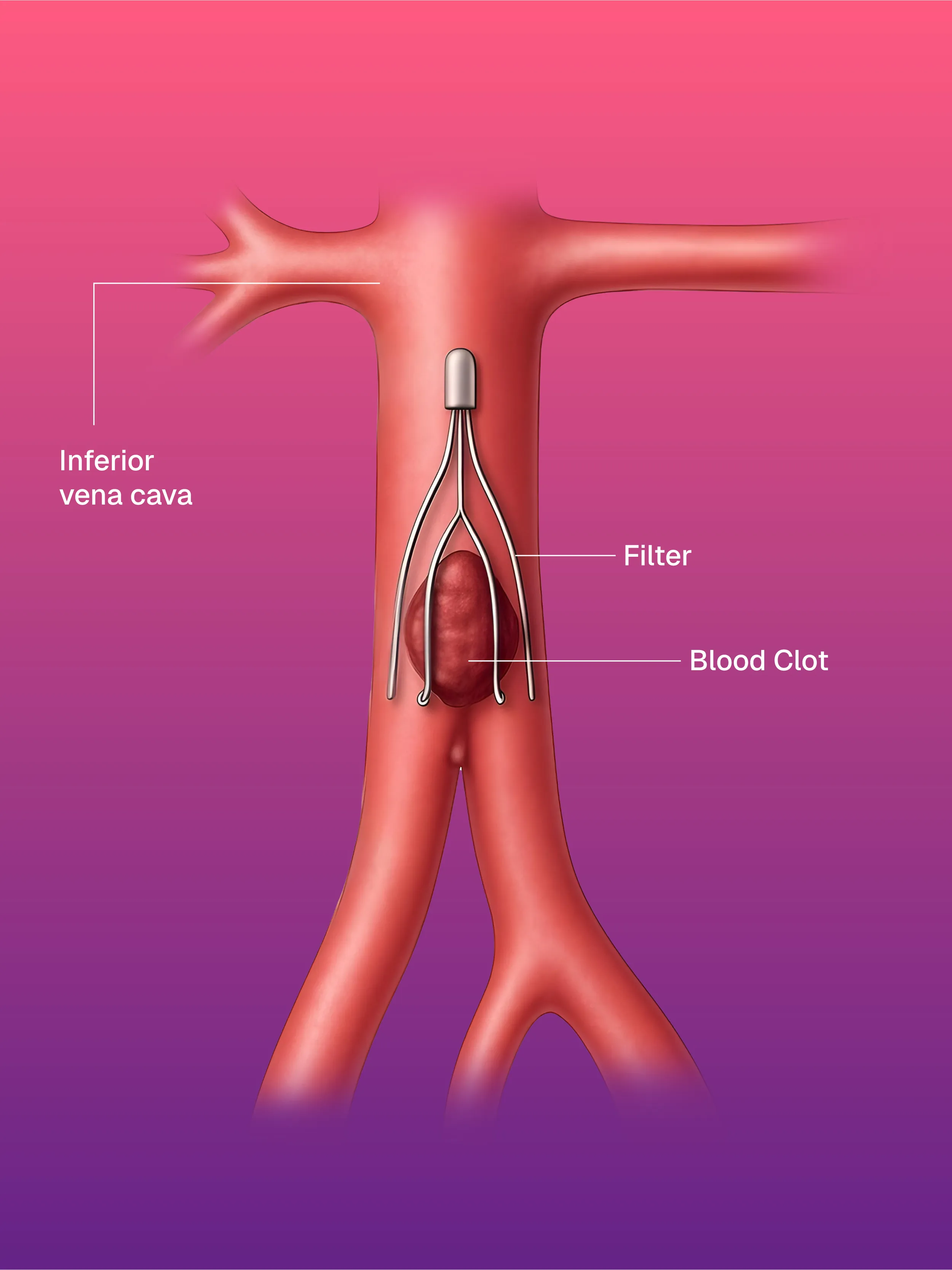 IVC Filter Placement