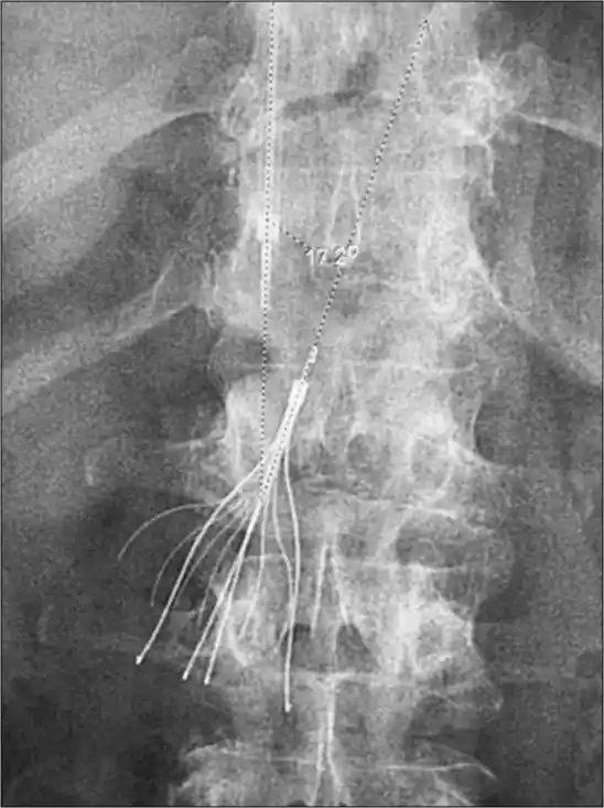 IVC Filter Placement in Mohali