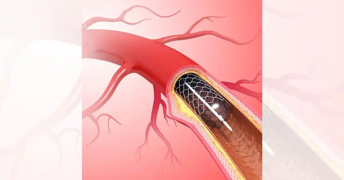 Peripheral Angioplasty